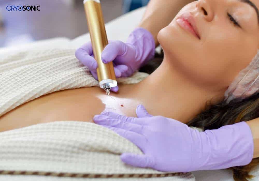 how cryotherapy works on cherry angiomas, with a focus on freezing the abnormal blood vessels Leeds
