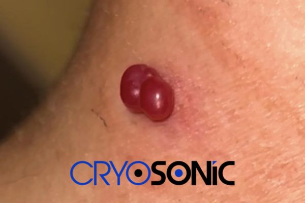 Large two-headed Cherry Angioma Leeds