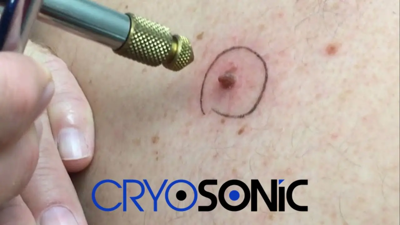 What Happens When A Mole Or Skin Tag Gets Frozen Off With Liquid Nitrogen Leeds